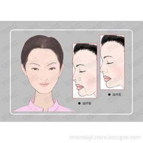 Cooling RF Skin Rejuvenation Thermage Fractional RF Cavitat